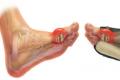 Gout - symptoms and treatment at home