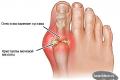 Gout - what is this disease, its signs and treatment