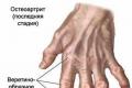 Шишки на пальцях рук причини і лікування