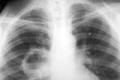 Purulent lung diseases