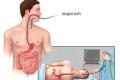 Erosive reflux esophagitis