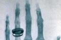 Wilhelm Roentgen.  Bức xạ tia X.  Máy chụp Xquang.  Lịch sử phát minh và sản xuất máy X-quang
